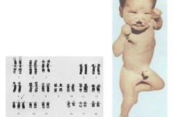 什么叫三体综合症,胎儿综合症有哪些