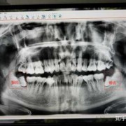 孕期拍牙片（孕期拍牙片,生下来小孩正常,对以后会不会有影响）