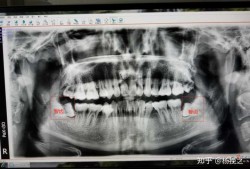 孕期拍牙片（孕期拍牙片,生下来小孩正常,对以后会不会有影响）