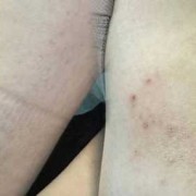 怀孕期间有褐色分泌物（怀孕期间有褐色分泌物正常吗）