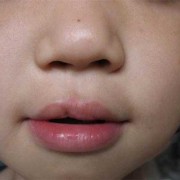 胎儿唇裂图片（胎儿唇裂图片真实）