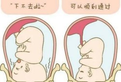 胎儿不入盆可以顺产吗（胎儿不入盆可以顺产吗?）