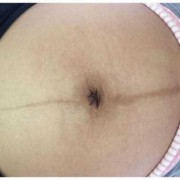 孕妇肚脐周围疼是怎么回事？孕妇肚子痛需要吃药吗,孕期肚脐里的脏东西可以清理吗