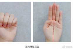 大排畸婴儿手握拳状态请问正常吗,胎儿小拳头滑来滑去男孩还是女孩啊