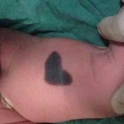 婴儿后背青怎么回事,胎儿身上青色的胎记是怎么回事