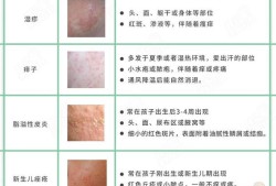 孕30周有湿疹怎么办,孕期吃什么防止湿疹复发