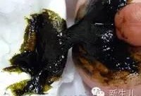 胎儿胎粪（胎儿胎粪怎么排出）