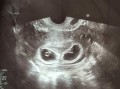 胎儿胚芽（胎芽多大的时候出现胎心）
