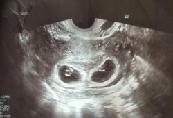 胎儿胚芽（胎芽多大的时候出现胎心）