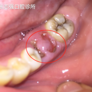 孕期牙断裂（牙齿断裂的原因）