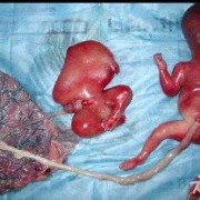 人死后有哪些特征,胎儿死胎的症状及征兆