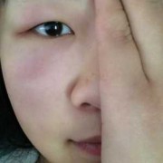 孕期眼睛疼是怎么回事（孕期眼睛疼是怎么回事）