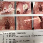 孕期阴道囊肿（孕期有囊肿怎么办）