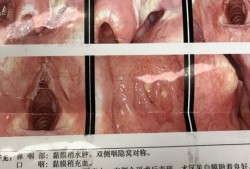 孕期阴道囊肿（孕期有囊肿怎么办）