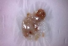 孕期总是感觉嗓子有痰怎么回事,孕期咳血痰是怎么回事啊