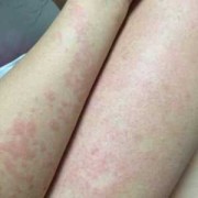 怀孕了皮肤过敏很痒怎么办,怀孕期间过敏了怎么办啊