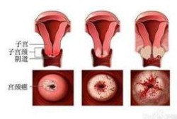 孕期阴道出血（孕期下面出血但不疼什么情况）