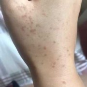 孕期手上长斑（脸上和手上都有斑点怎么办）