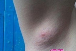 孕期腋下淋巴（孕期腋下淋巴结肿大正常吗）