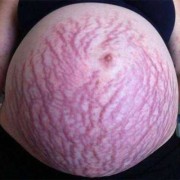 孕期妊娠纹图片（孕期妊娠纹图片大全）