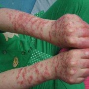 得了红斑狼疮怀孕了怎么办,孕期红斑狼疮是什么症状