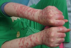 得了红斑狼疮怀孕了怎么办,孕期红斑狼疮是什么症状