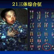 孕期特征（怀了唐氏儿的孕妇特征有哪些呢）
