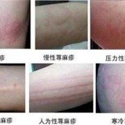孕期荨麻疹怎么办（孕期荨麻疹怎么办?）