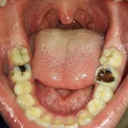 孕期蛀牙（孕期蛀牙疼痛难忍怎么缓解）