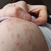 孕期乳房湿疹怎么治疗（乳房湿疹结痂破皮该怎么办）