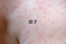 孕期湿疹到产后怎么办（孕期湿疹到产后怎么办啊）