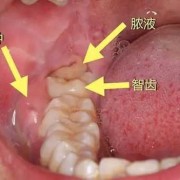 孕期智齿发炎怎么办（孕期智齿发炎怎么办,一边脸都肿了）