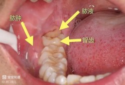 孕期智齿发炎怎么办（孕期智齿发炎怎么办,一边脸都肿了）