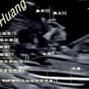 怎样让胎儿动起来（做nt怎样让胎儿动起来）