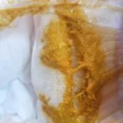 孕期屎尿多（孕妇一天大便七八遍，这是很正常吗）