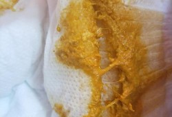 孕期屎尿多（孕妇一天大便七八遍，这是很正常吗）