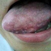 孕期感染疱疹（怀孕三个月，嘴唇上长疱疹了，怎么办）