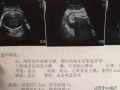 胎儿b超数据标准对照表（胎儿侧脑室宽度正常值是多少）