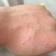 梅毒孕妇生下的孩子会怎样,梅毒对胎儿有影响吗梅毒好治吗