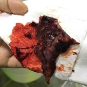 胎儿生化是什么症状（生化妊娠为什么会腹痛的啊？还是很想知道的）