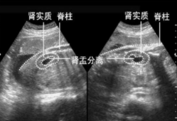 胎儿双肾分离是男孩吗（胎儿双肾分离是男孩吗?）