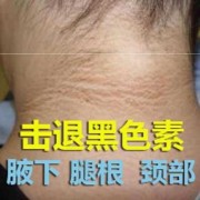 孕期黑色素沉淀严重（皮肤黑色素沉淀怎么办?有什么办法可以去除的）