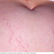 孕期妊娠纹图片（孕期妊娠纹图片大全）