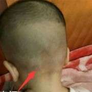 胎儿囟门（胎儿囟门位置示意图）