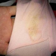 怀孕中期，乳头有裂痕是怎么回事,