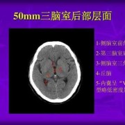 胎儿第三脑室（三脑室及双侧脑室大怎么回事）
