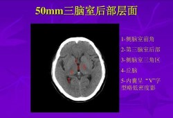 胎儿第三脑室（三脑室及双侧脑室大怎么回事）