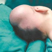 为什么剖腹产的宝宝还会有头颅血肿？这属于手术造成的吗,胎儿头皮水肿什么原因