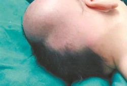为什么剖腹产的宝宝还会有头颅血肿？这属于手术造成的吗,胎儿头皮水肿什么原因