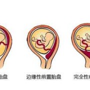 我想问一下胎盘距离宫颈口多少厘米才算前置胎盘呀,前置胎盘的胎儿偏小吗
